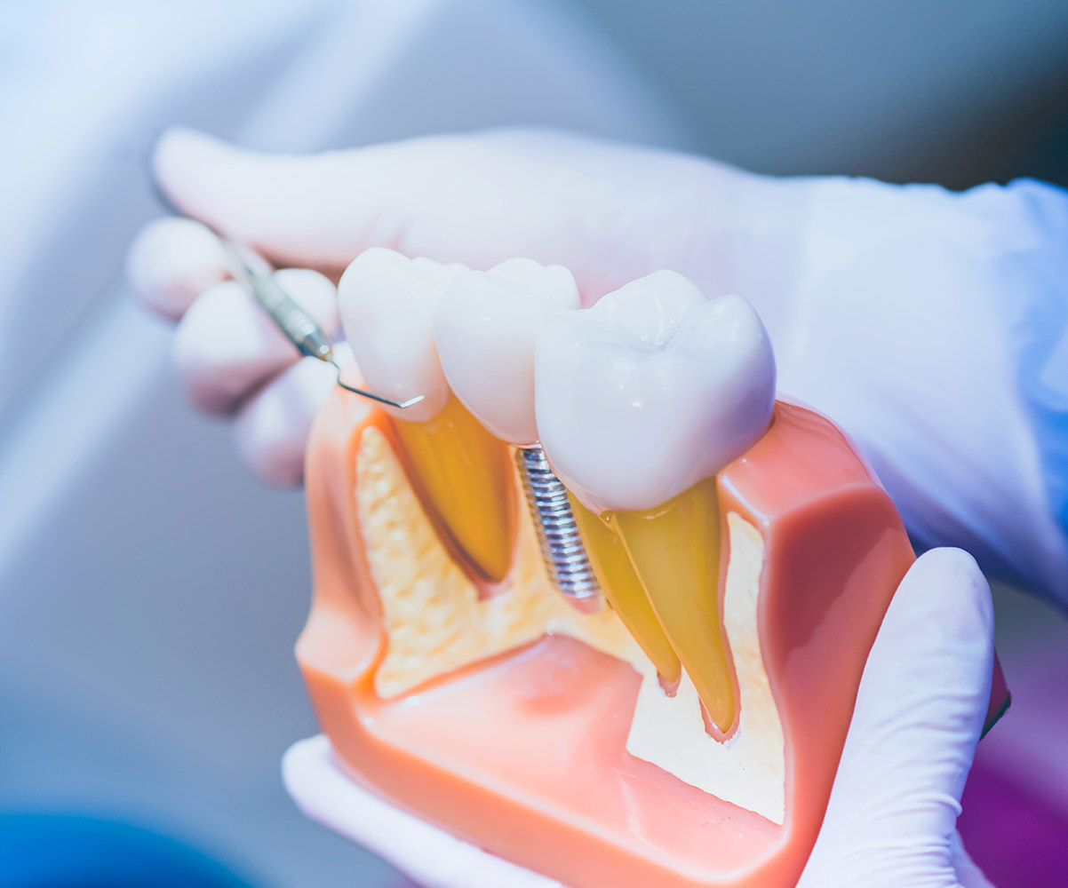 Dental Blush implants2 Dental Implants in Miami Florida.  