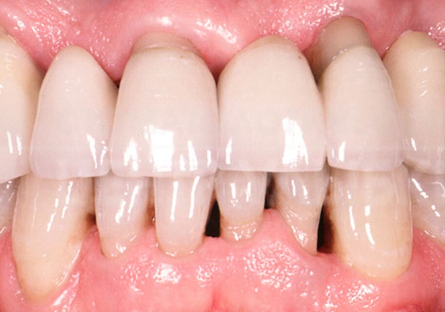 Dental Blush periodontitis Periodontics Services in Miami Florida  