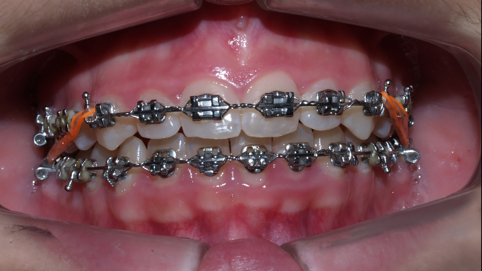 Dental Blush orthodontics Orthodontics for Good Dental Health Orthodontics  Dentist Dental Health Dental Clinic Miami dental blush  