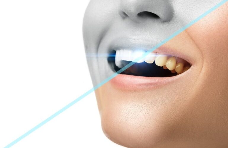 Dental Blush Teeth-Whitening-Treatment-770x500 Teeth Whitening Treatment Dental  