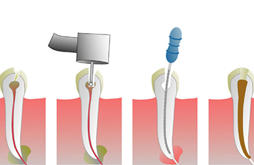 Dental Blush root_canal-770x500 Get your smile back with Root Canal Treatment Dental  root canals Root Canal Treatment in Miami Root Canal Treatment 