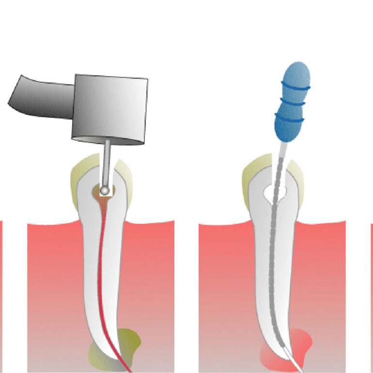 Удаление нерва зуба сколько болит