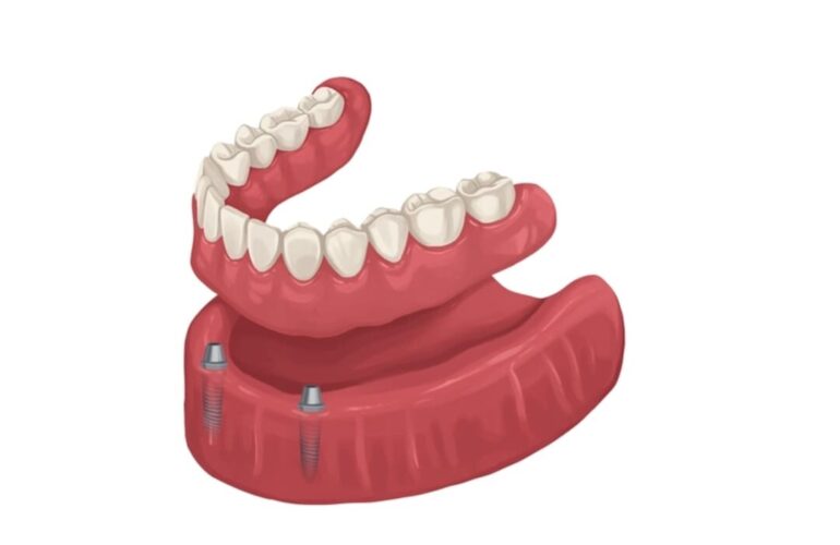 Dental Blush overdenture-770x500 Our Services  