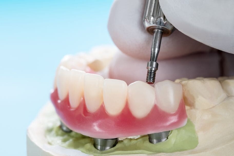 Dental Blush overdenture Guide to Overdentures in Miami: Types, Benefits, and Best Alternatives Dental  Overdentures in Miami Overdentures Implant overdentures Benefits Of Overdenture 