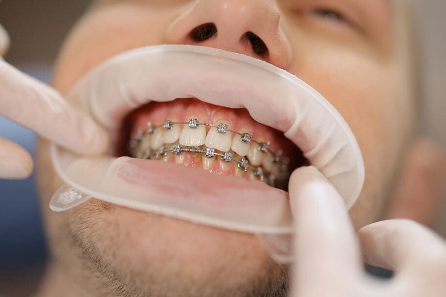 Dental Blush Orthodontics Orthodontics Services in Miami, FL  