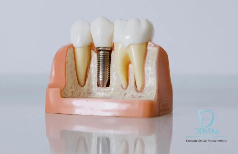 Dental Blush Tamiami FL 3-3-770x500 Dentures in Tamiami Is It Safe To Sleep With? Dental  