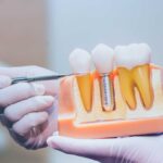 Dental Blush Dental-Implants-150x150 Dental implants, am I a candidate for this treatment? Dental  
